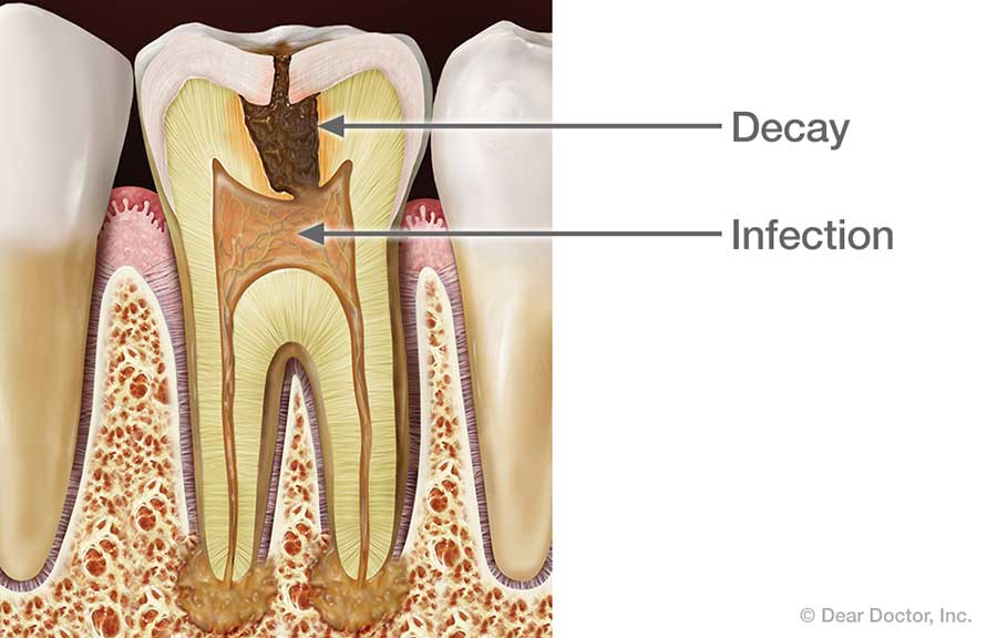 Root Canal Infection.